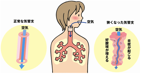 咳喘息